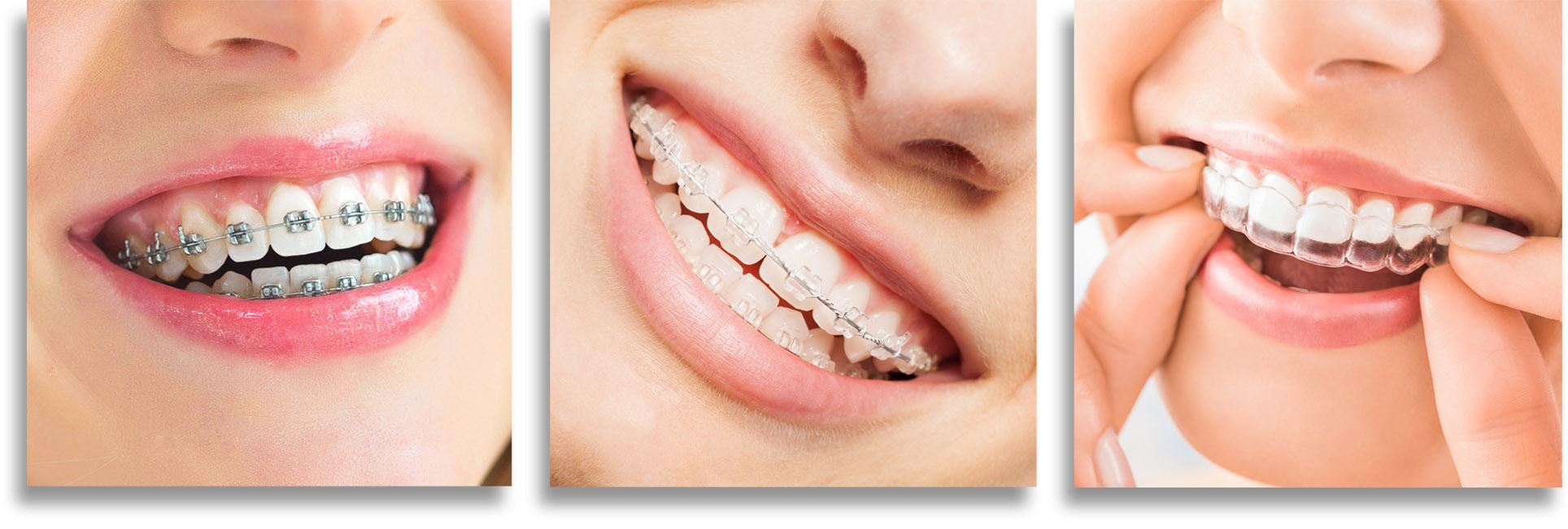 The Pros and Cons of Ceramic Braces - Belmont Smiles - Orthodontist  Belmont, MA